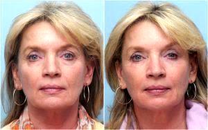 Radiesse To The Lower Face,Restylane Under The Eyes, And Botox To The Forehead. By Dr. David Mabrie,San Francisco