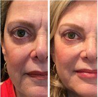 Reduce The Brow Lift