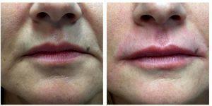Rejuvenation Around The Mouth And Lips By Anusha H. Dahanayake, NP, Doctor In Los Angeles, California