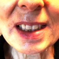 Remove Wrinkles By Temporarily Paralyzing Facial Muscles