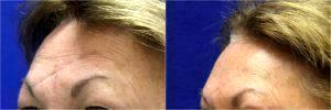 Restylane Filler For Scar By Dr. S. Randolph Waldman, Lexington Facial Plastic Surgeon (1)