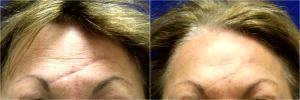 Restylane Filler For Scar By Dr. S. Randolph Waldman, Lexington Facial Plastic Surgeon (2)