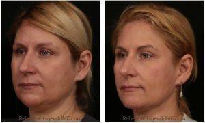Restylane Lyft, Kybella And Dysport By Dr. Rebecca Fitzgerald, Cosmetic Dermatologist In Los Angeles, Beverly Hills, Larchmont (2)