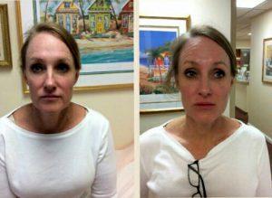 Restylane Lyft To Help The Jawline, Restylne Silk For Under The Eyes & Lipstick Lines At Dr. Merey's Medical Bariatric & Rejuvenation Center In West Palm Beach