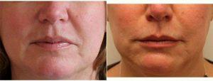 Restylane To The Nasolabial Folds By Doctor Kimberly Lee, MD, Beverly Hills Facial Plastic Surgeon