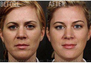 Sculptra Aesthetic By Dr. Rebecca Fitzgerald, Cosmetic Dermatologist In Los Angeles, Beverly Hills, Larchmont