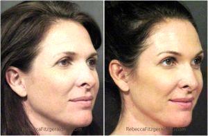 Sculptra, Juvederm, Botox, Dysport By Dr. Rebecca Fitzgerald, Cosmetic Dermatologist In Los Angeles, Beverly Hills, Larchmont (2)