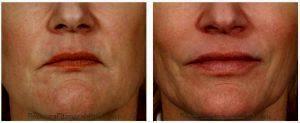 Sculptra, Restylane, Botox Masseter By Dr. Rebecca Fitzgerald, Cosmetic Dermatologist In Los Angeles, Beverly Hills, Larchmont