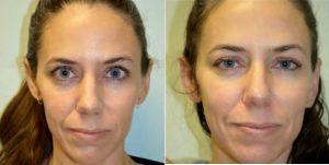 Sculptra Was Injected To The Midface, Zygoma And Nasolabial Folds. By Dr. Ana Carolina Victoria, MD, Miami Oculoplastic Surgeon