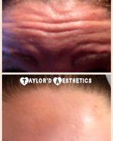 Some Degree Of Forehead Movement Following Botox Is A Good Thing