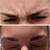 How Long Does Botox Take To Work On Frown Lines? » Facial ...