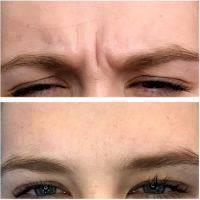 TREATMENTS FOR FROWN LINES