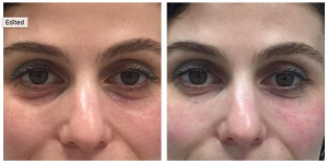 Tear Trough Filled With Restylane By Anusha H. Dahanayake, NP, Doctor In Los Angeles, California