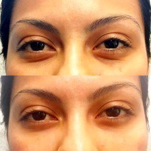 Tear Trough Injections At Beverly Hills Rejuvenation Center
