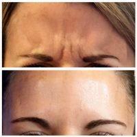 The Areas Of Treatment With BOTOX Include The Frown Lines Between The Eyes