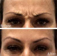 The Best Treatment For Frown Lines Is Botox
