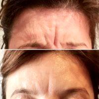 The Silky-smooth Results Of Botox