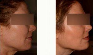 Under Jaw Shaping With Botox With Dr Andrea Hui, MD, San Francisco Dermatologic Surgeon