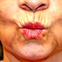 Upper Lip Wrinkles & Lines