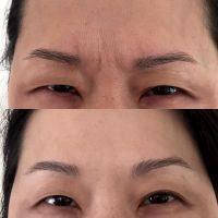 Vertical Lines Between Brows Before And After