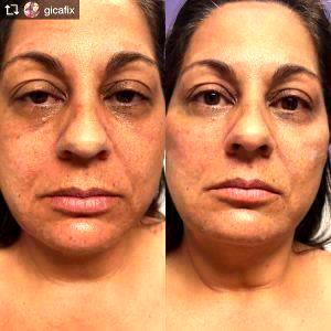 Voluma Injections We Used A Total Of 3 Syringes And Achieved A Natural Look At National Laser Institute Med Spa, Scottsdale, AZ