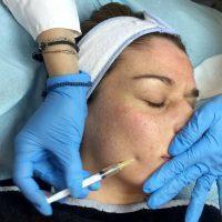 What Restrictions And Regimen Should Be Followed After The Botox Application
