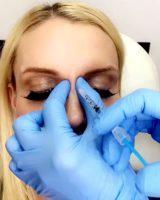 What To Do DURING Botox