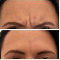 You Will Need To Have The Botox Procedure Repeated To Maintain The Same Results