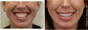 28 Year Old Woman Treated With Botox For Gummy Smile By Parker A. Velargo, MD,New Orleans