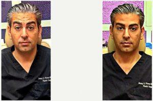 38 Year Old Man Treated With Botox With Doctor Jimmy S. Firouz, MD, FACS, Beverly Hills Plastic Surgeon