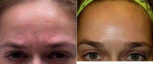 39 Year Old Woman Treated With Botox With Doctor Karen Beasley, MD, Baltimore Dermatologic Surgeon