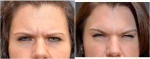 40 Year Old Woman Treated With Botox By Dean P. Kane, MD, FACS,Baltimore