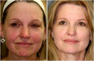 40Units Of Botox And 2.3ccs Of Radiesse By Dr. Marcia V. Ormsby, MD,Baltimore