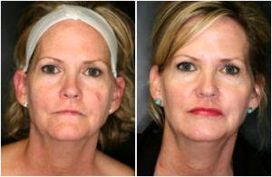 50Units Of Botox, 1cc Of Juvederm, And 2.3ccs Of Radiesse By Dr. Marcia V. Ormsby, MD,Baltimore