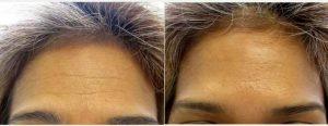 54 Year Old Woman Of Color Treated With Botox For Forehead With Dr Benjamin Barankin, MD, FRCPC, Toronto Dermatologic Surgeon