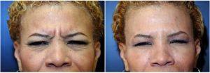 54 Year Old Woman Treat With Botox By Dean P. Kane, MD, FACS,Baltimoreed
