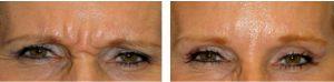 54 Yr Old Female Botox For Glabella Lines (the 11's) (while Frowning) By Dr. Yeilding, M.D.,Orlando