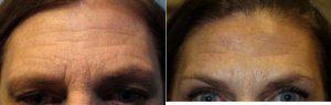 57 Year Old Woman Treated With Botox With Dr Karen Beasley, MD, Baltimore Dermatologic Surgeon