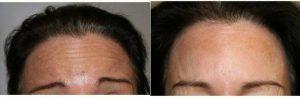57 Year Old Woman Treated With Botox With Dr. Payman Danielpour, MD, FACS, Beverly Hills Plastic Surgeon