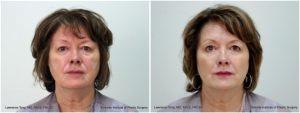 A Combination Of Perlane And Restylane Fine Lines Using A Total Of 8cc's By Dr. Tong, MD,Toronto