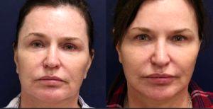 A Comprehensive Approach With Bellafill And Other Injectables, Such As Botox By Dr. Andre Berger,M.D.,Beverly Hills