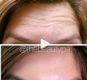 A Patient Started Botox Treatment For Prevention Of Fine Lines And Wrinkles By Dr. Gary Motykie,M.D.,Beverly Hills