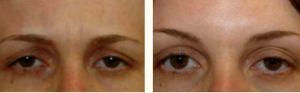 Before & After Photos Botox Injections By Dr. Greenberg,M.D.,Orlando