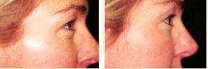 Before & After Photos Botox Treatment By Dr. Greenberg,M.D.,Orlando