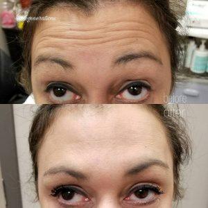 Before And 2 Weeks After Being Treated For Wrinkles Between The Eyes And Forehead With Botox Cosmetic At The Regenerations Cosmetic Medicine,Knoxville.