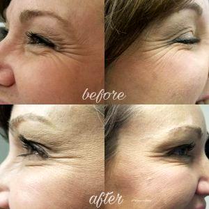 Before And 2 Weeks After Treatment Of Botox Cosmetic At Regenerations Cosmetic Medicine,Knoxville