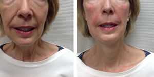 Before And After 1 Juvederm Ultra Plus XC And 2 Juvederm Voluma XC By Brooke Bentley, FNP,Knoxville