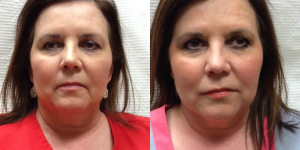 Before And After 1 Syringe JUVÉDERM Ultra Plus XC And 2 Syringes JUVÉDERM Volbella XC By Brooke Bentley, FNP,Knoxville