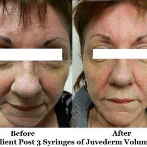 Before And After 3 Syringes Of Juvederm Voluma By Ashley Pontenberg Our Nurse Practitioner,Orlando