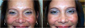 Before And After Botox For Crow's Feet By Dr. Reath,MD,Knoxville
